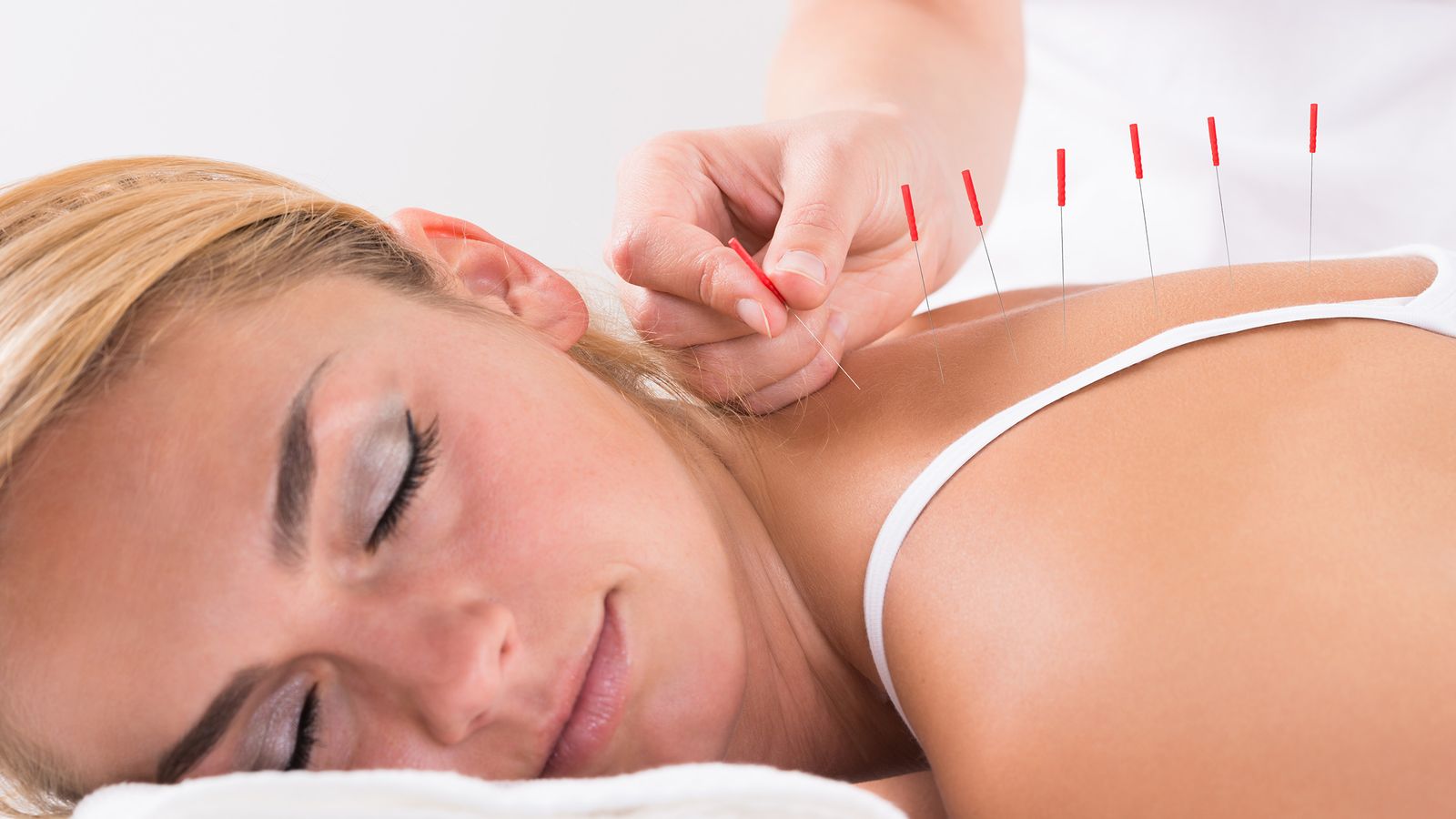 Entspannte Frau bekommt eine Akupunktur-Behandlung