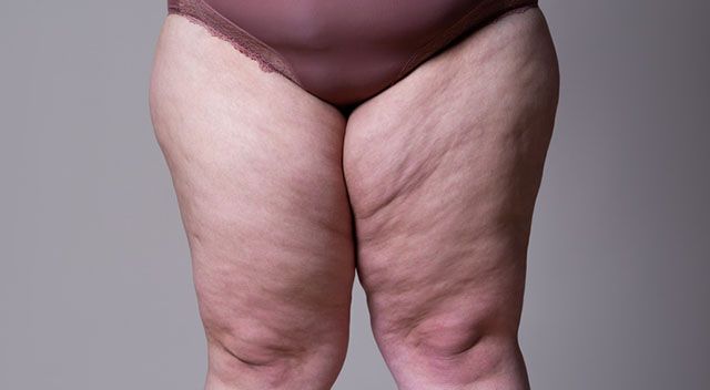 Übergewichtige Frau mit Lipödem am Unterkörper