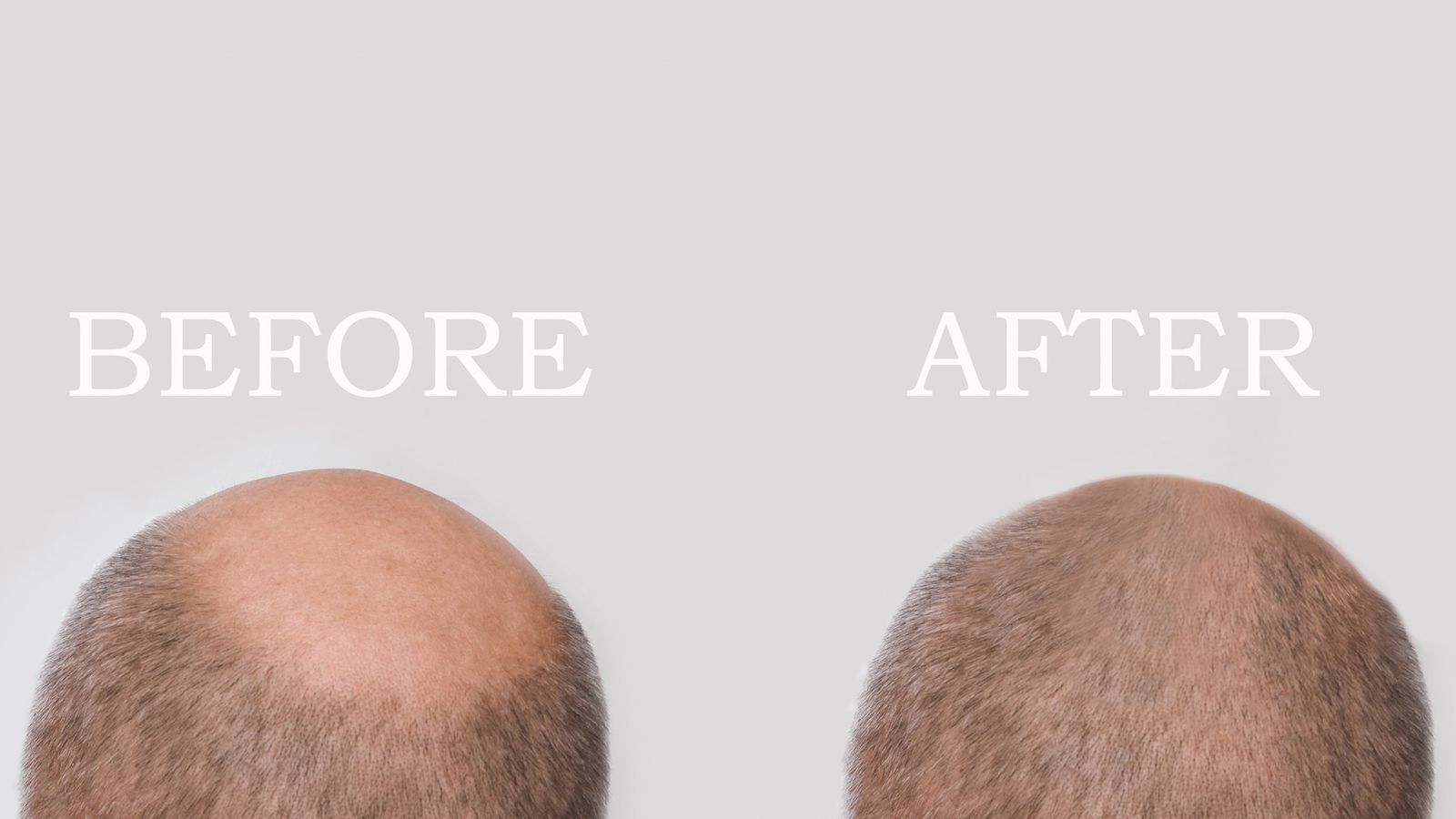 Mann vor und nach einer Therapie gegen Glatze