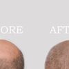 Mann vor und nach einer Therapie gegen Glatze