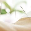 Hitzewallungen und Akupunktur