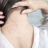 Diffuser Haarausfall bei einer Frau mit dunklen Haaren