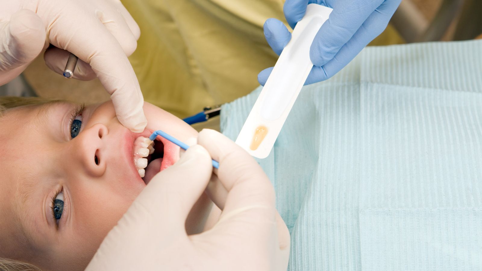 Kind bekommt eine Fluoridbehandlung vom Zahnarzt