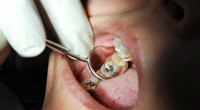 Zahnbehandlung mit Quecksilber