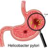 Helicobacter pylori Bakterien im menschlichen Magen