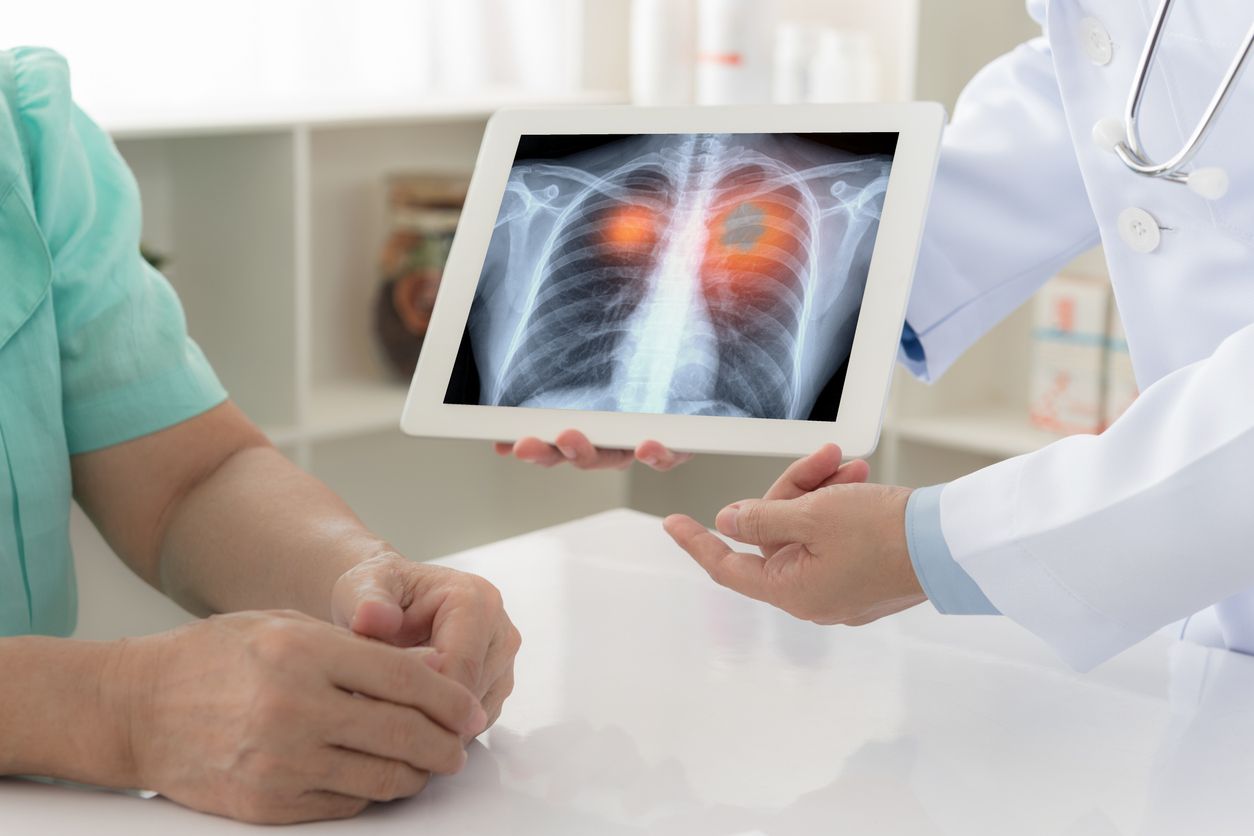 Arzt zeigt Röntgenbild mit Lungekrebs